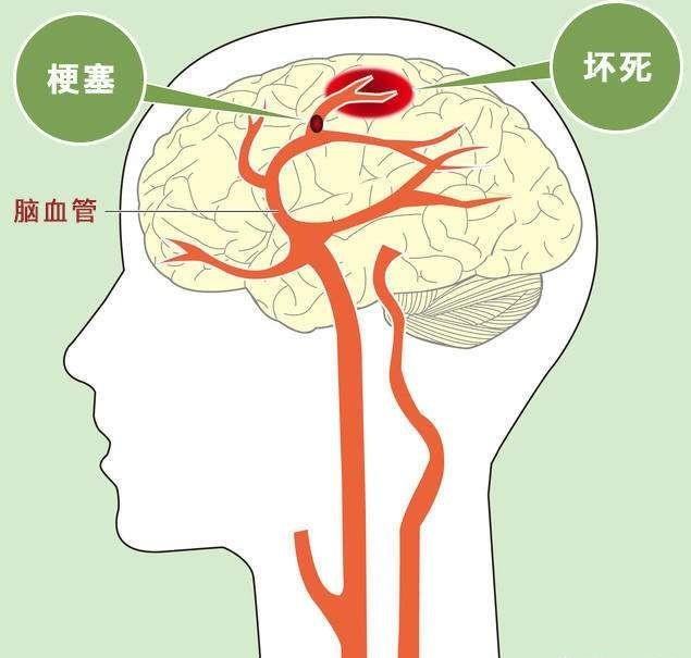 预防脑血栓生活中怎么做